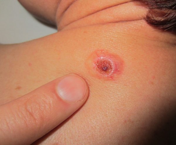 cancer-de-piele 1