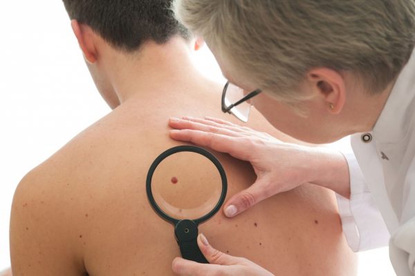 cancer-de-piele